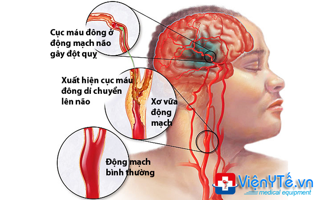 bien-chung-cua-benh-cao-huyet-ap-tai-bien-mach-mau-nao
